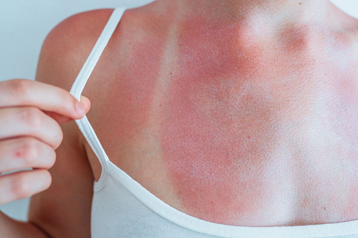 Sonnenbrand im Zollernalbkreis: Richtig vorbeugen, schnell b